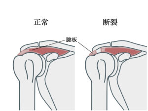 肩の腱板断裂・インピンジメント