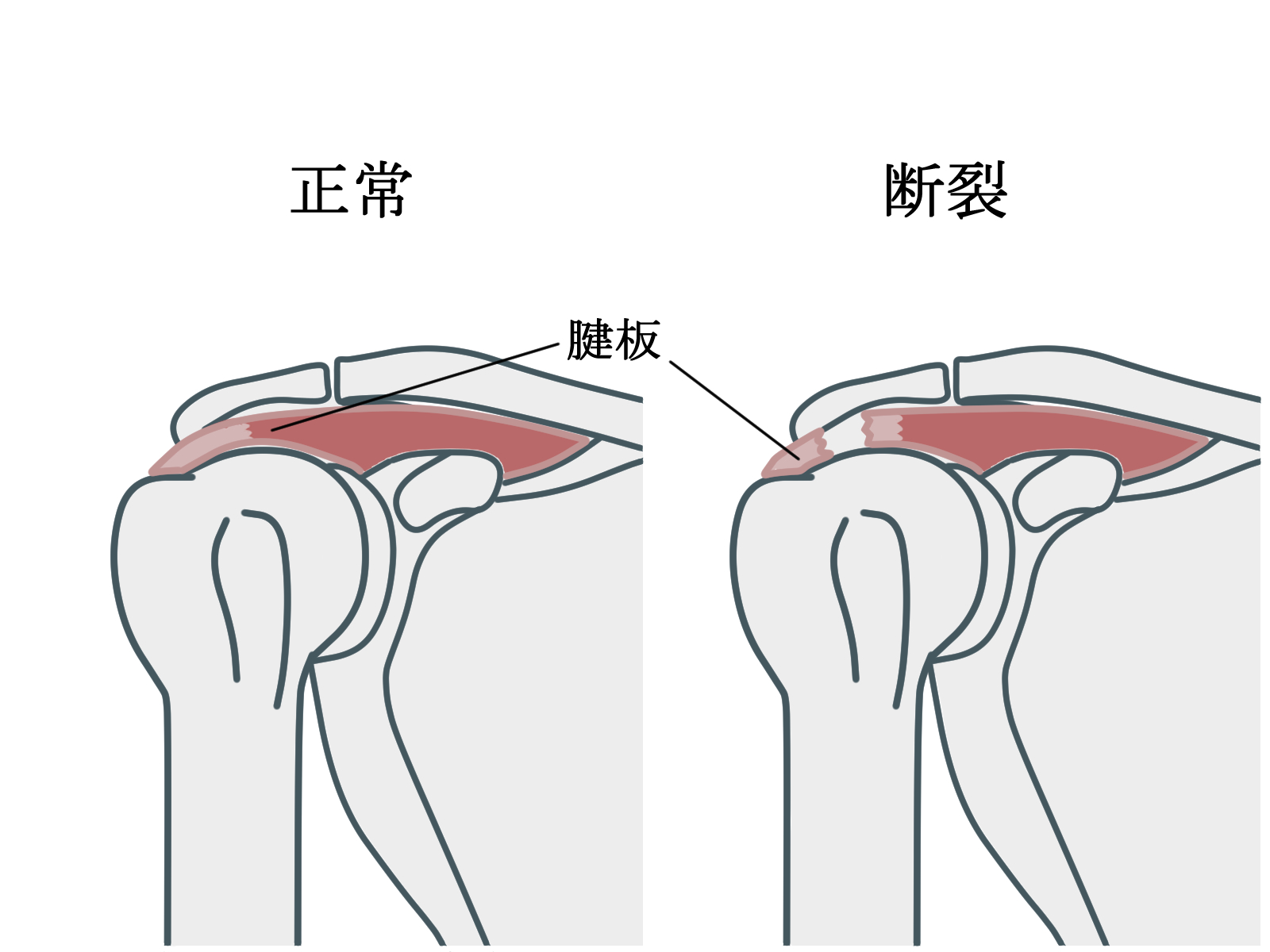 肩の腱板断裂・インピンジメント